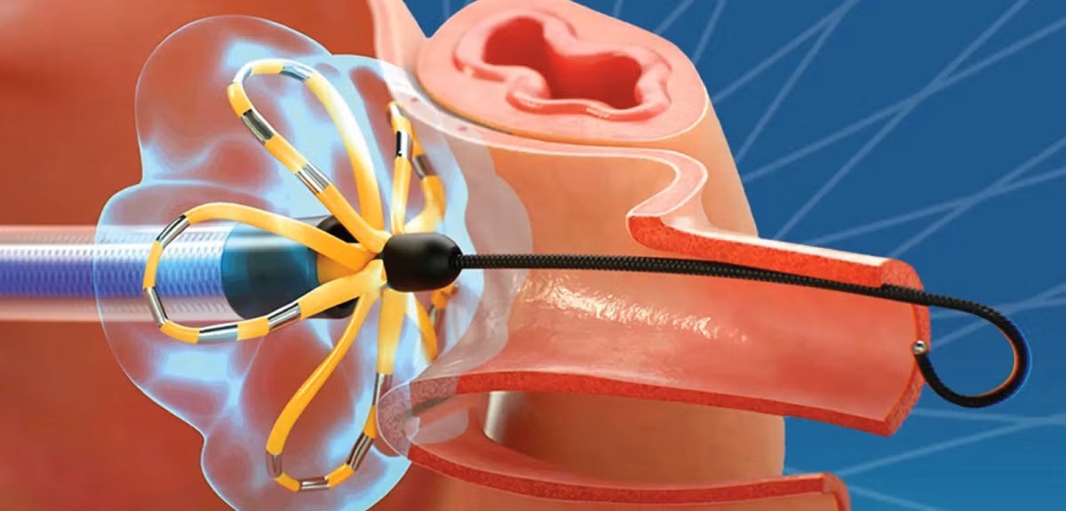 درمان آریتمی با پالس الکتریکی برای نخستین بار در کشور