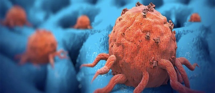 علائم هشداردهنده سرطان مری را بشناسید