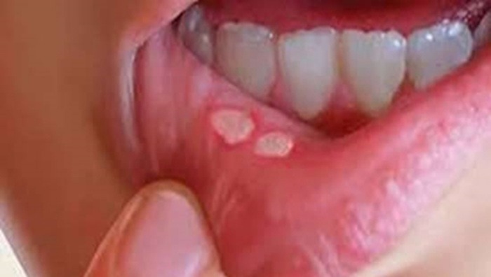 هشدار نسبت به علائم خاموش سرطان‌های دهان