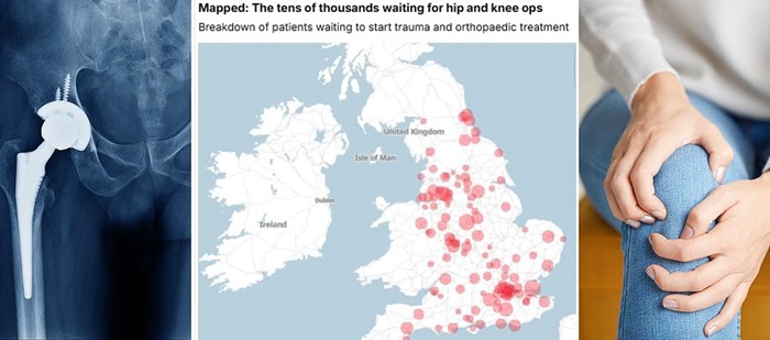 بحران کمبود سیمان استخوانی در بیمارستان‌های انگلستان