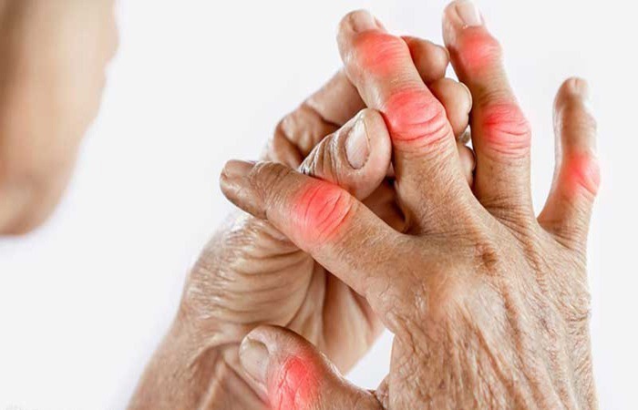 سن شایع روماتیسم بین ۲۰ تا ۵۰ سالگی است