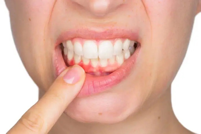 تشخیص دقیق، کلید کنترل سندرم سوزش دهان