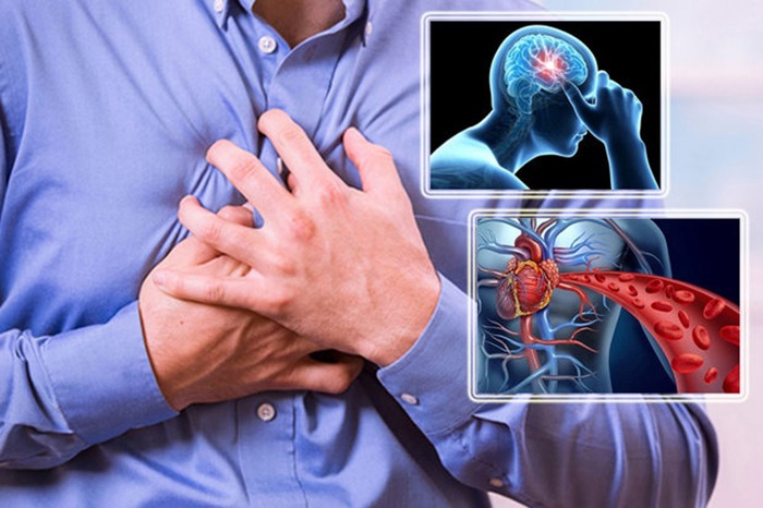 سکته قلبی همیشه با درد شدید آغاز نمی‌شود