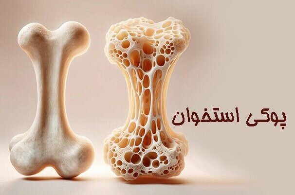 ۳۰ درصد افراد بالای ۵۰ سال خراسان شمالی به پوکی استخوان مبتلا هستند